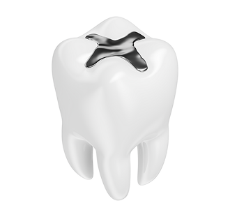 補牙 - Vee Dental 護齒牙科