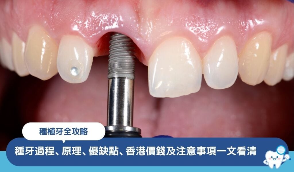 種植牙全攻略