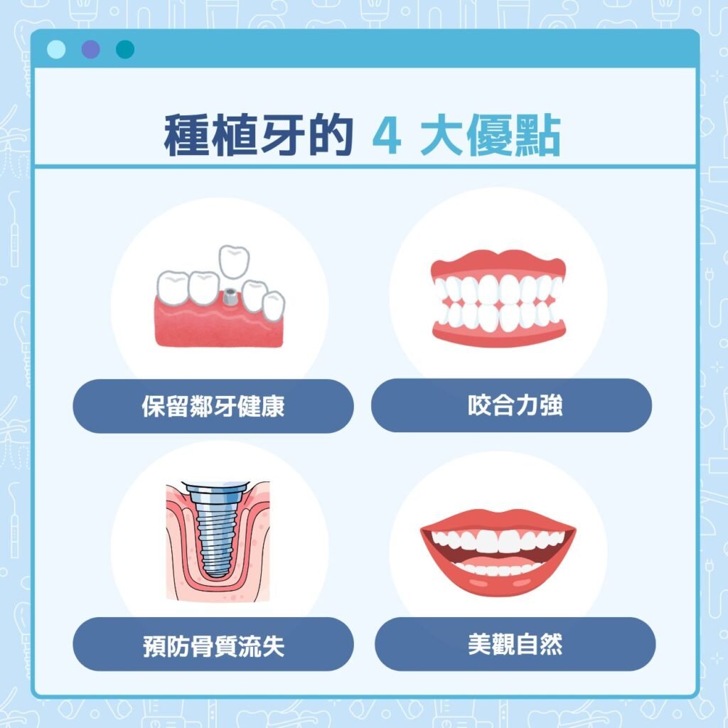 種植牙的4大優點