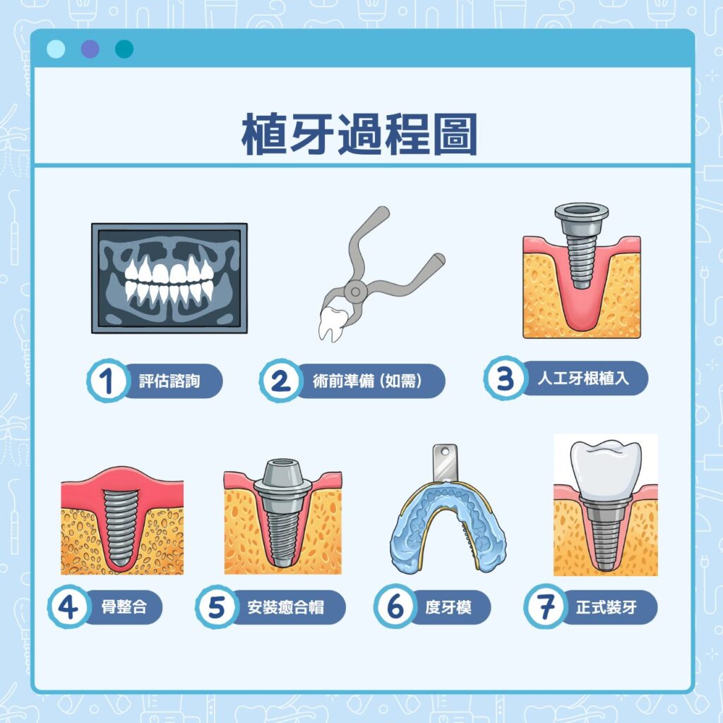 植牙過程圖
