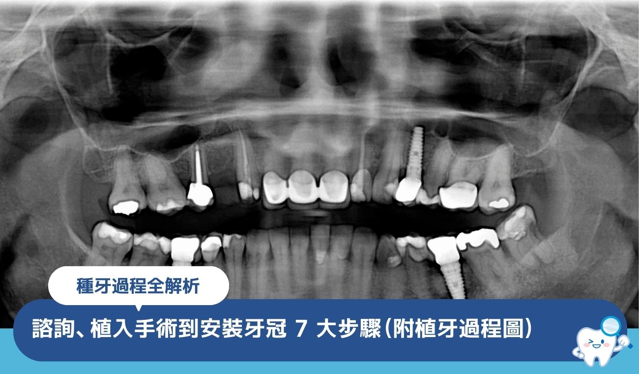 種牙過程全解析