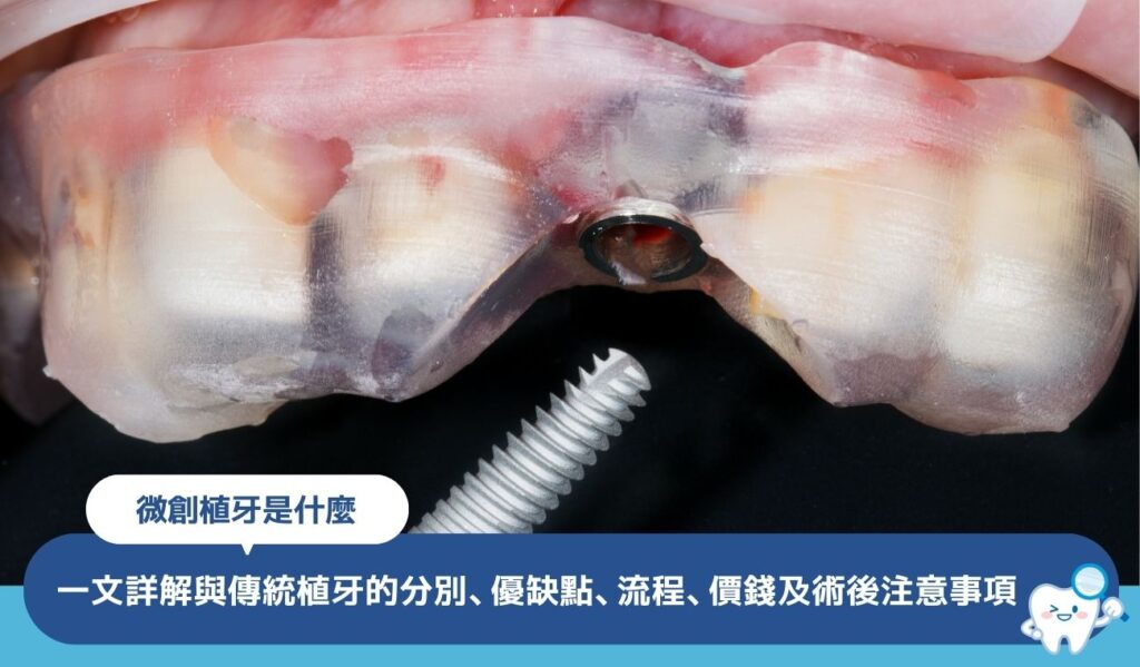 微創植牙是什麼？