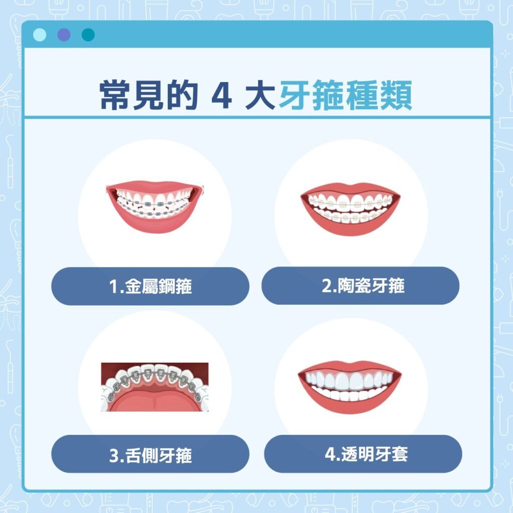 常見的4大牙箍種類