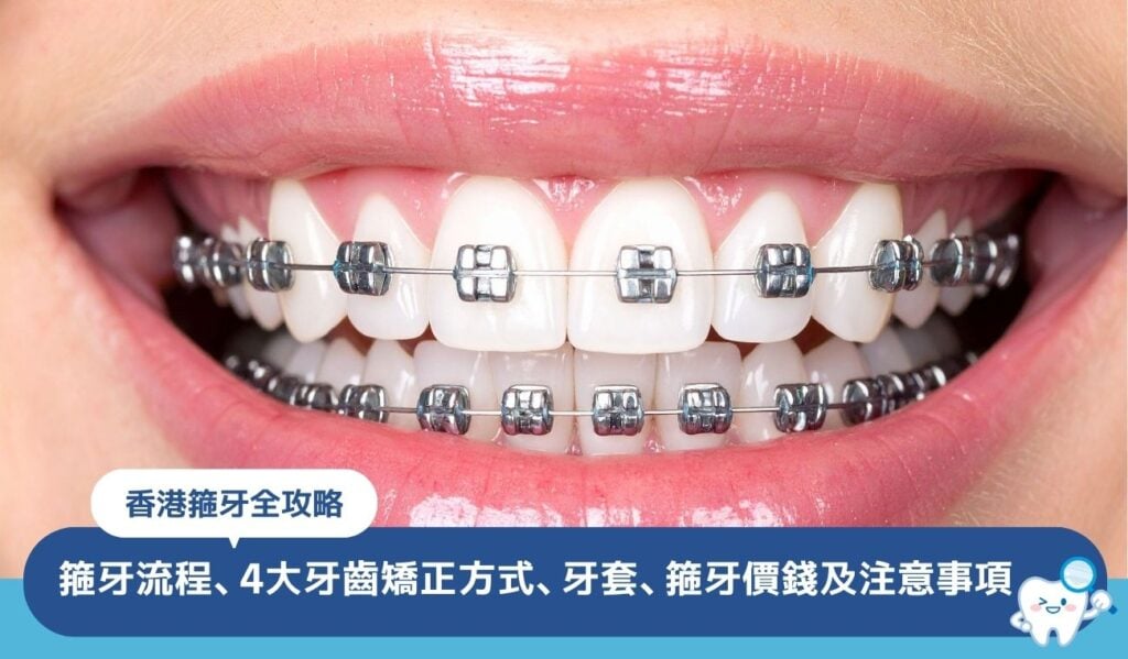 香港箍牙全攻略