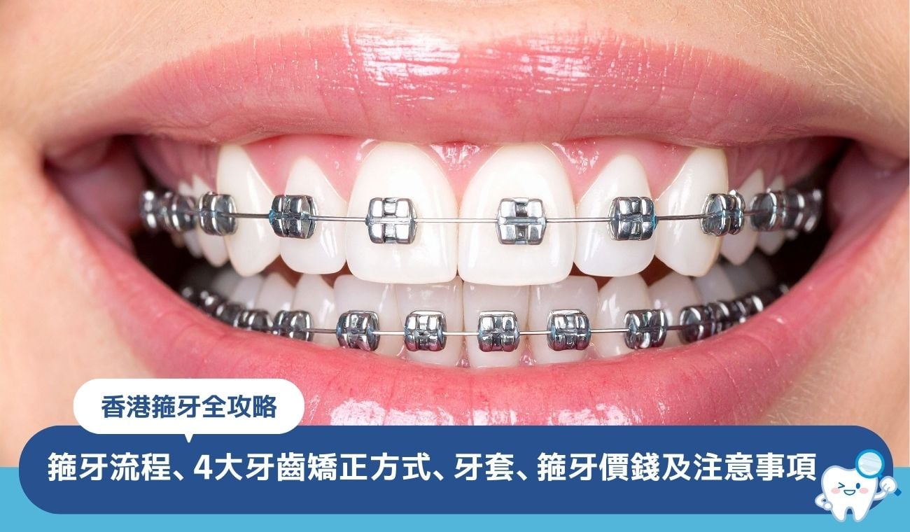 香港箍牙全攻略