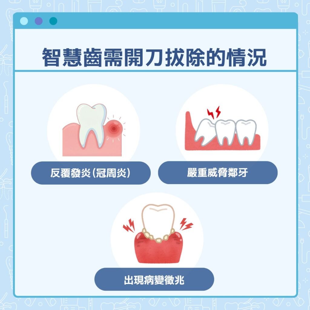 智慧齒需要開刀拔除的情況