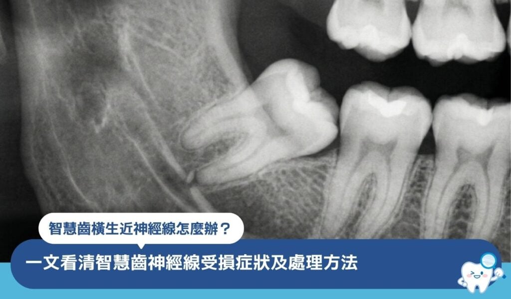 智慧齒橫生近神經線怎麼辦?