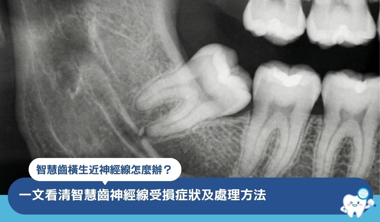 智慧齒橫生近神經線怎麼辦?