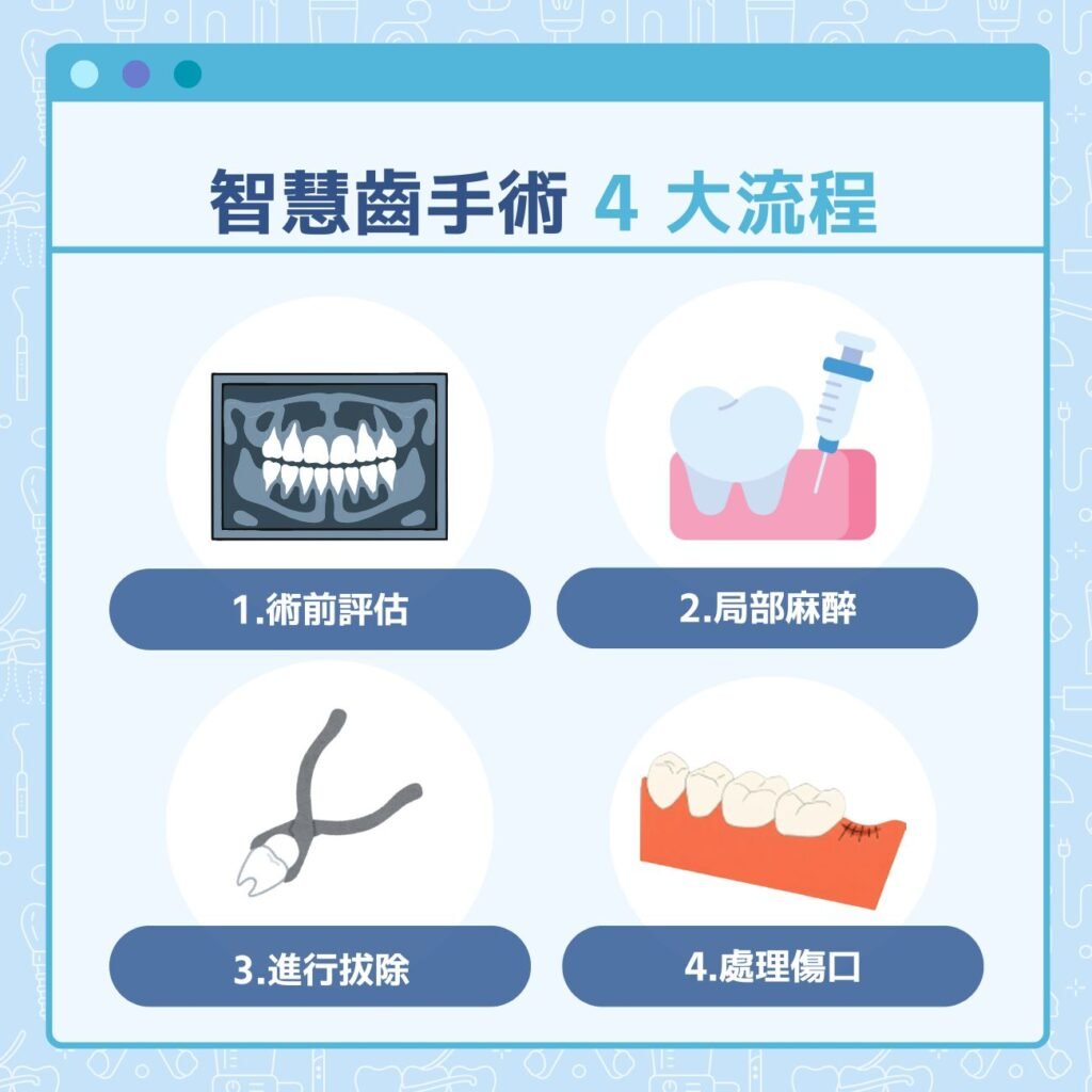 智慧齒手術 4 大流程