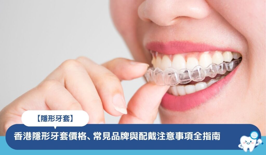隱形牙套全指南