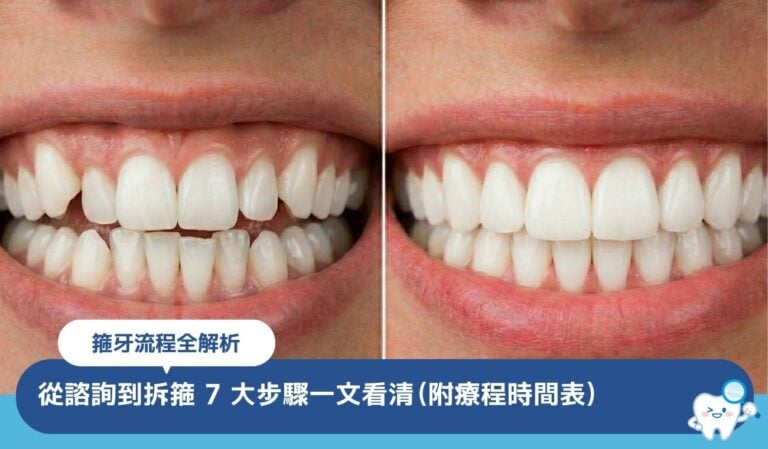 箍牙流程全解析