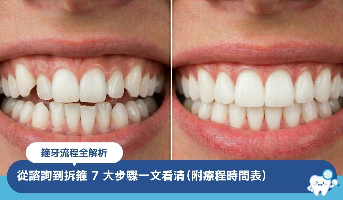 箍牙流程全解析