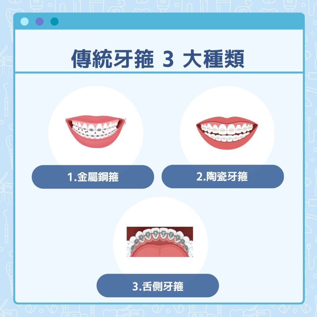傳統牙箍3大種類