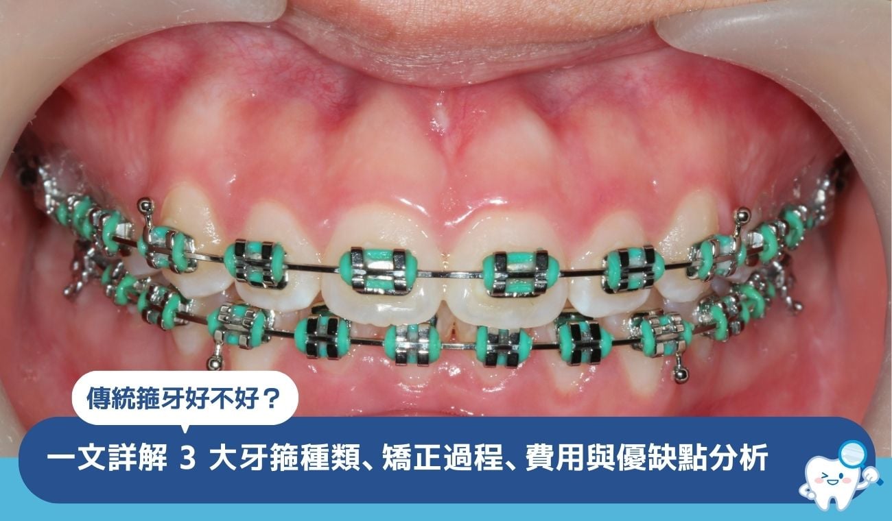 傳統箍牙好不好?