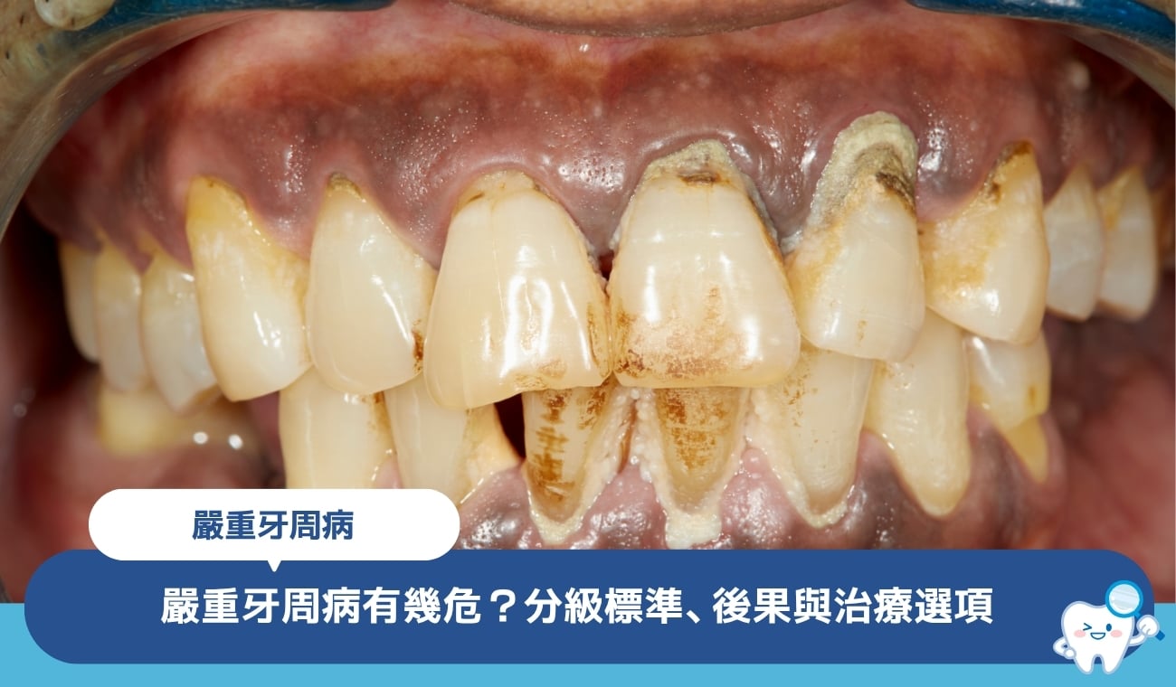 嚴重牙周病有幾危?