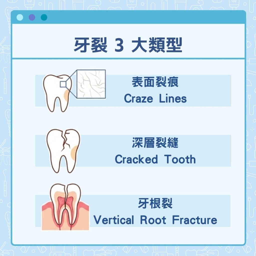 牙裂有幾種類型?