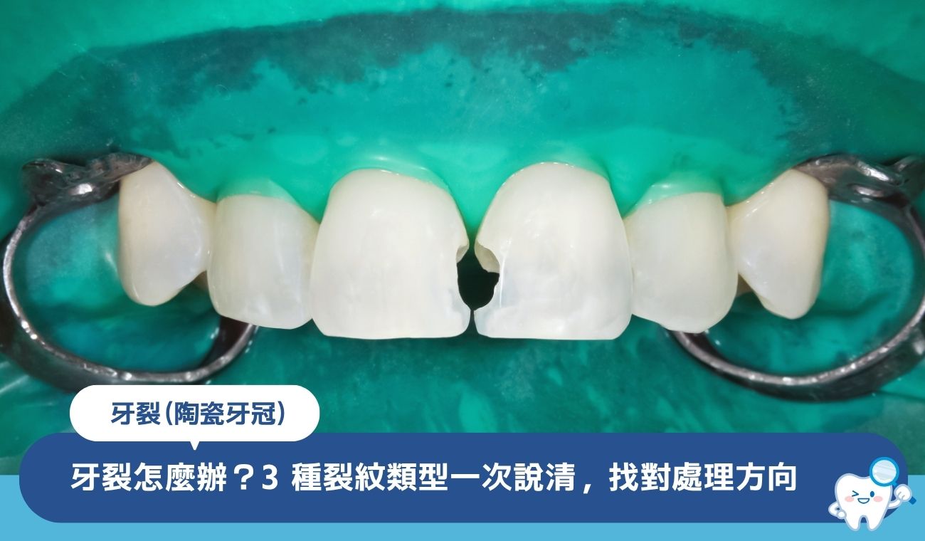 牙裂怎麼辦?3 種裂紋類型一次說清,找對處理方向