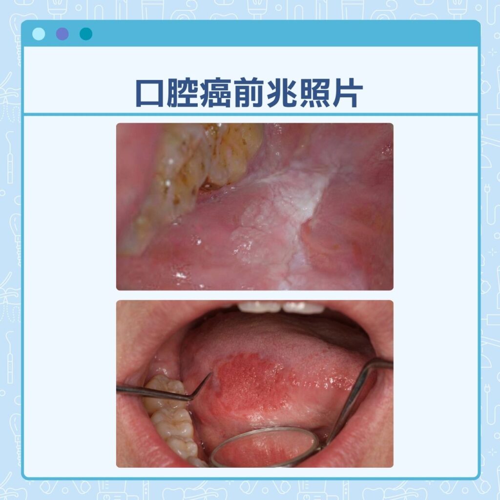口腔癌前兆照片