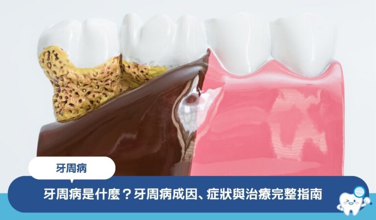 牙周病是什麼?牙周病成因、症狀與治療完整指南