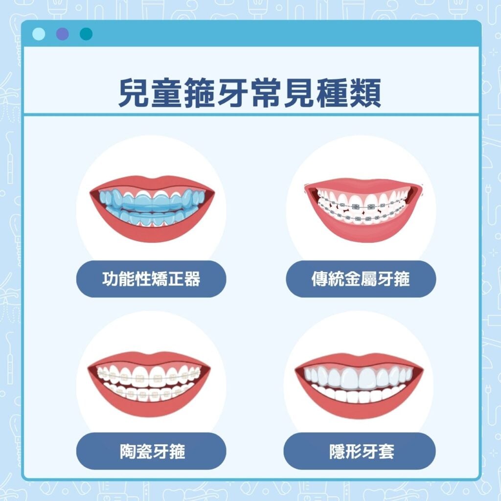 兒童箍牙常見種類