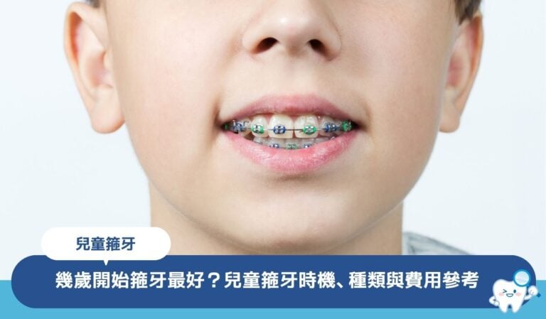 幾歲開始箍牙最好?兒童箍牙時機、種類與費用參考