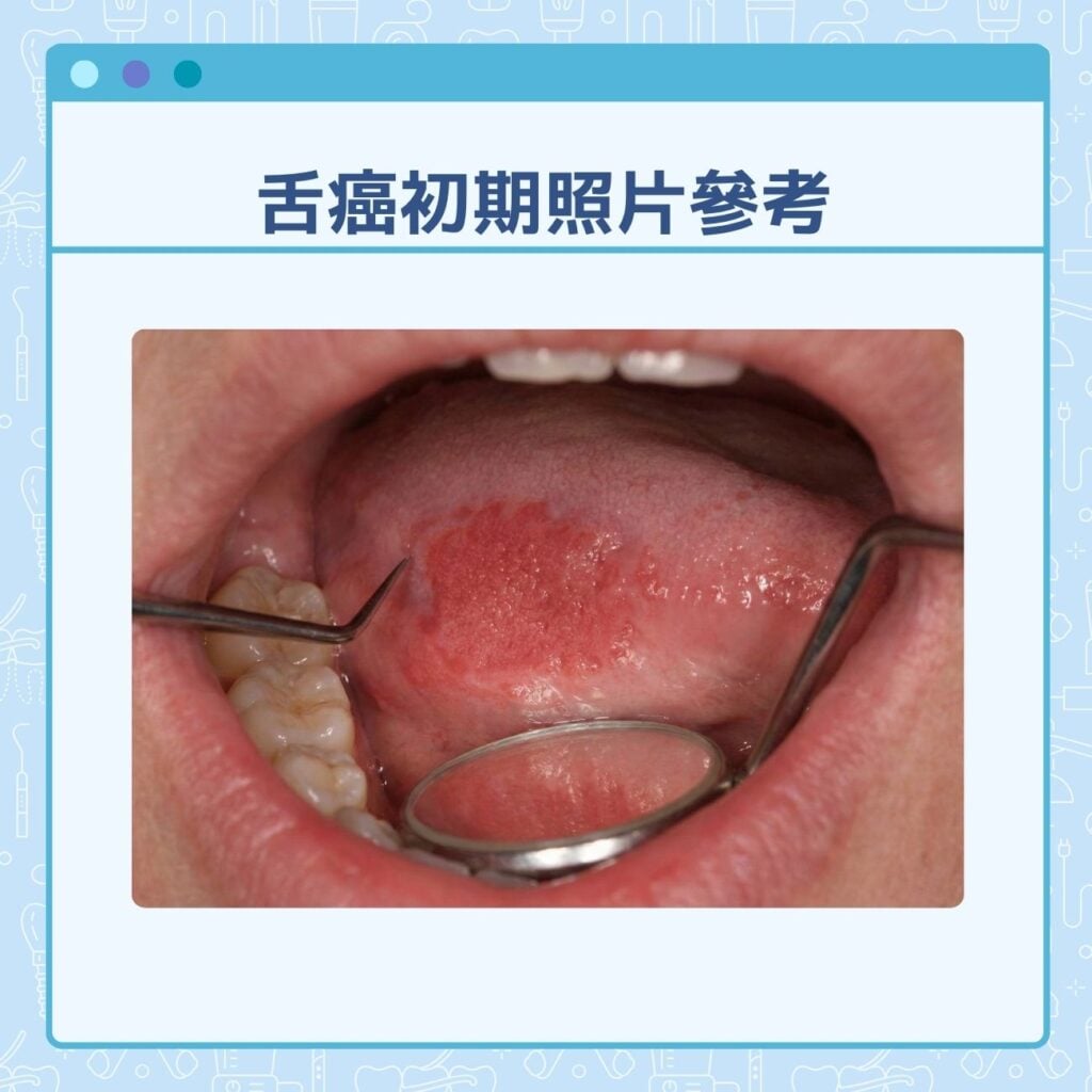舌癌初期照片