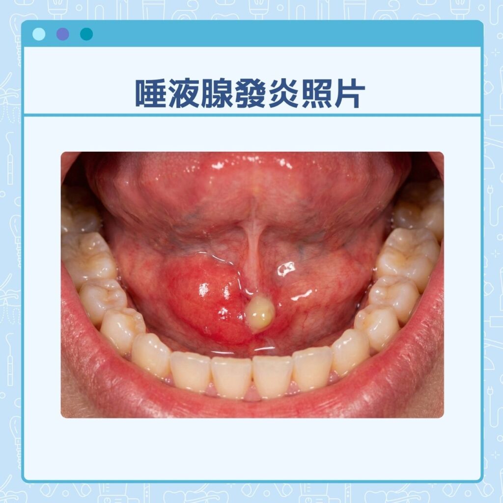 唾液腺發炎照片