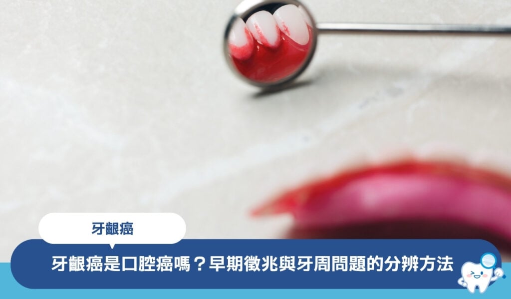 牙齦癌是口腔癌嗎？6大早期徵兆與牙周問題的分辨方法