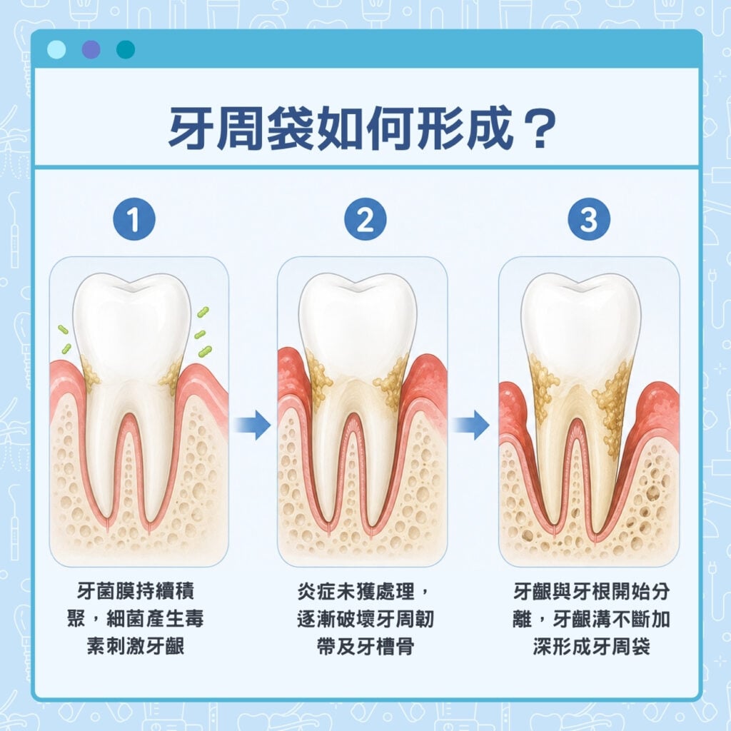 牙周袋如何形成?