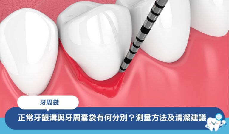 牙周袋是什麼？正常牙齦溝與牙周袋有何分別？測量方法及清潔建議一文了解